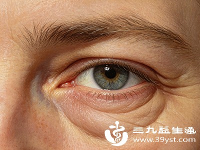 针对不同类型的眼袋,以下方法能快速缓解症状 针对不同类型的眼袋,以下方法能快速缓解症状