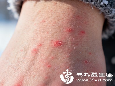 除了病毒感染和过敏，一些炎症性皮肤病也会伴随水泡症状