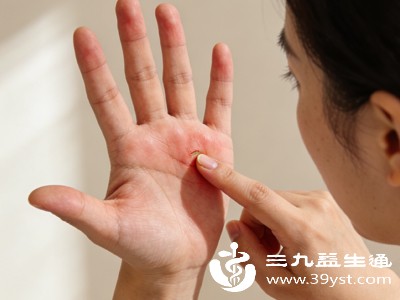 手心容易被蚊虫叮咬,尤其是夏季,蚊虫叮咬后会释放毒液,刺激皮肤引发瘙痒,通常表现为孤立的小红点,瘙痒感比较集中 手心容易被蚊虫叮咬,尤其是夏季,蚊虫叮咬后会释放毒液,刺激皮肤引发瘙痒,通常表现为孤立的小红点,瘙痒感比较集中