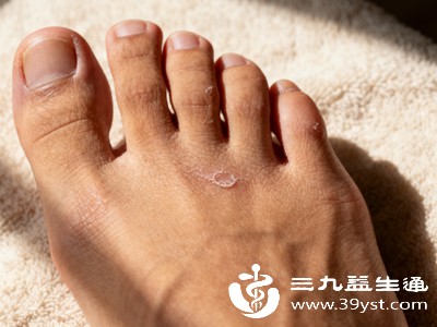 若摩擦破损、局部压痛明显,可做好防护,贴上防磨护垫,减少鞋子与骨骼凸起处的摩擦,避免反复破损发炎,杜绝增生、骨赘加重问题 若摩擦破损、局部压痛明显,可做好防护,贴上防磨护垫,减少鞋子与骨骼凸起处的摩擦,避免反复破损发炎,杜绝增生、骨赘加重问题