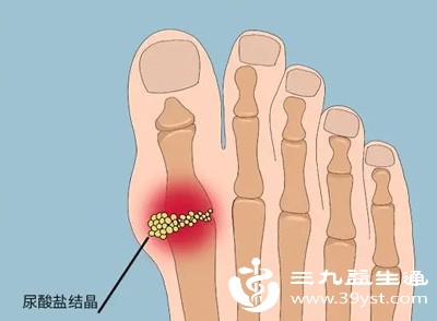 痛风或高尿酸，疼痛剧烈易反复