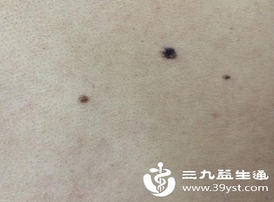 黑痣变大=不好的信号 别瞎猜 正确应对方法看这篇