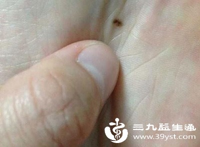 女性在怀孕、哺乳期,体内激素水平发生变化,也可能刺激色素细胞活性增强,让原本的黑痣轻微变大、凸起,产后激素水平恢复后,大多会恢复稳定 女性在怀孕、哺乳期,体内激素水平发生变化,也可能刺激色素细胞活性增强,让原本的黑痣轻微变大、凸起,产后激素水平恢复后,大多会恢复稳定