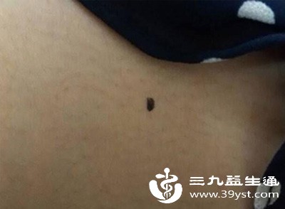 当皮肤出现炎症、过敏等问题时,也可能影响到黑痣 当皮肤出现炎症、过敏等问题时,也可能影响到黑痣