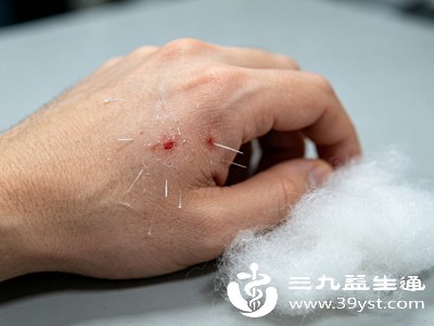 手上扎了玻璃纤维别乱抠 这套完整处理步骤亲测管用