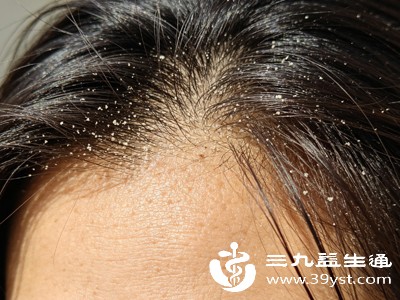 穿黑衣服就尴尬 一文搞懂头屑暴涨的真相 轻松摆脱“雪花头”