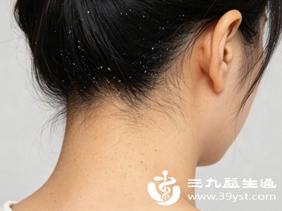 穿黑衣服就尴尬 一文搞懂头屑暴涨的真相 轻松摆脱“雪花头”