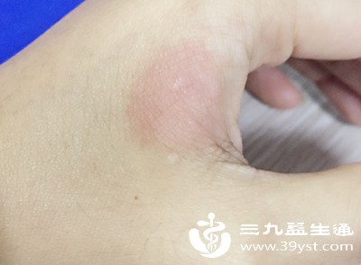 被烫了别乱涂 正确急救四步走 轻松减少伤害不留疤