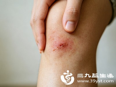 伤口发痒分生理性和病理性两种,对症区分是养护的第一步 伤口发痒分生理性和病理性两种,对症区分是养护的第一步