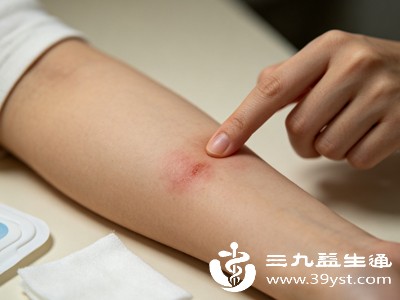 伤口发痒时,绝大多数人会下意识抓挠、抠痂、撕扯死皮,这是养伤最大的误区 伤口发痒时,绝大多数人会下意识抓挠、抠痂、撕扯死皮,这是养伤最大的误区