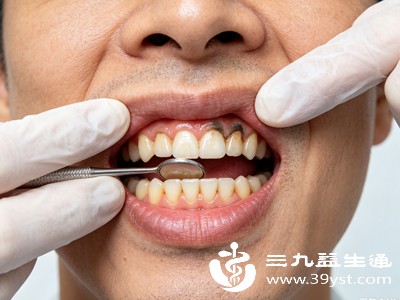 若牙龈突发大面积发黑、伴随肿痛、出血、黏膜破损,且调理后无改善,需及时就医检查,排除口腔病变、内分泌异常等问题,避免拖延病情 若牙龈突发大面积发黑、伴随肿痛、出血、黏膜破损,且调理后无改善,需及时就医检查,排除口腔病变、内分泌异常等问题,避免拖延病情