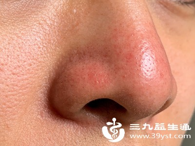 挤痘一时爽小心留疤又感染 不同痘痘处理方法不同