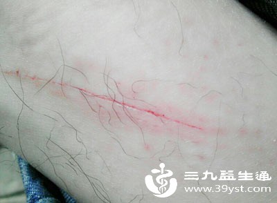 伤口愈合关键在拆线 晚拆影响全知道 科学应对看这里