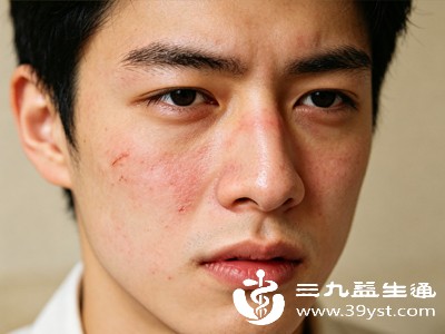 过敏引起的疙瘩多表现为风团、丘疹或红斑,颜色可呈淡红色、鲜红色或肤色,大小不一,可孤立分布或融合成片 过敏引起的疙瘩多表现为风团、丘疹或红斑,颜色可呈淡红色、鲜红色或肤色,大小不一,可孤立分布或融合成片