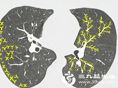 肺部实质病变 肺部实质病变