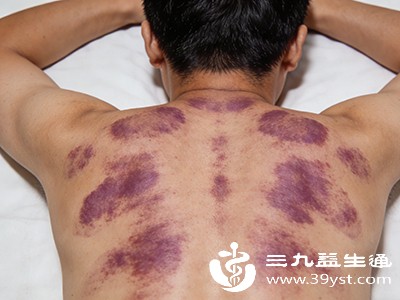 刮痧后身体毛孔处于张开状态，容易受到风寒侵袭，需及时增添衣物