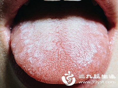 舌苔白腻 舌苔白腻
