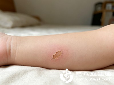 消毒风干后，不要让伤口长期裸露在外
