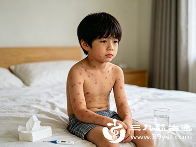 病毒感染是儿童出疹的重要原因 病毒感染是儿童出疹的重要原因