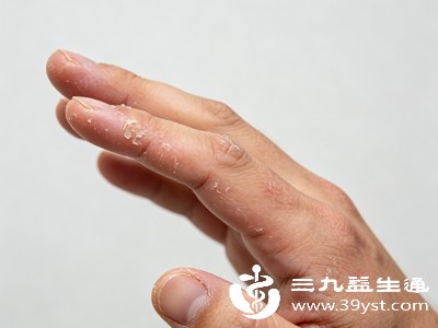 除了维生素缺乏，手蜕皮还可能由多种非营养因素引起，这些因素在日常生活中更为常见，需要加以区分