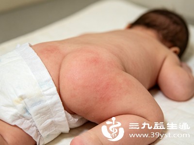 宝宝红屁股怎么办 香油不是万能的 正确护理才关键