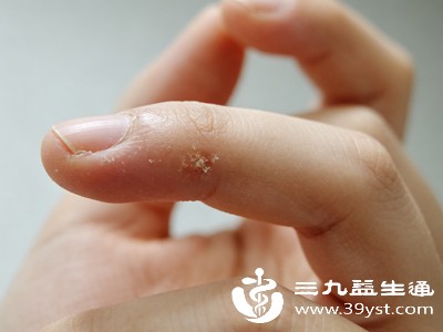 部分手指缝溃烂属于病理性皮肤问题，需要精准区分，避免盲目调理