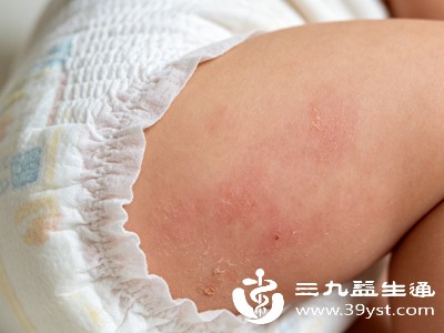 当女婴出现严重红臀、皮肤感染或湿疹等问题时，家长若过度依赖紫草油等偏方，可能会延误及时就医和规范治疗
