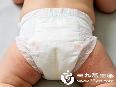 避免给女婴穿紧身衣物，保持室内温度适宜，减少汗液刺激皮肤