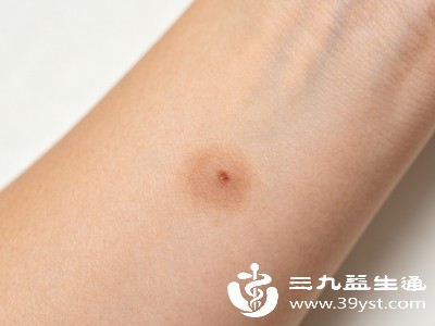 点痣留褐印别焦虑 掌握正确护理方式 看它如何一步步消退不见
