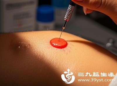 点痣方法的选择和操作过程中造成的创伤程度，对褐色印子的形成和消退也有重要影响
