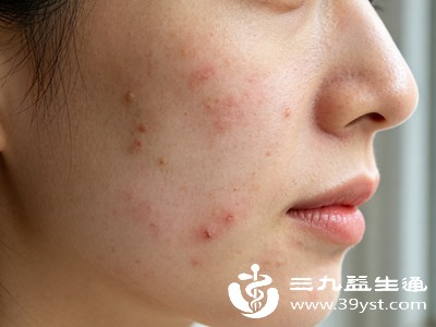 佩戴的口罩、眼镜等物品，如果清洁不及时，也会滋生细菌，与两腮皮肤长时间接触后，容易诱发痘痘