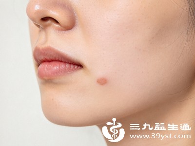凹陷性伤疤常见于痤疮愈合后、皮肤深度损伤或感染后，表现为皮肤表面出现凹陷，主要是由于伤口愈合过程中胶原蛋白流失过多或皮下组织缺损导致