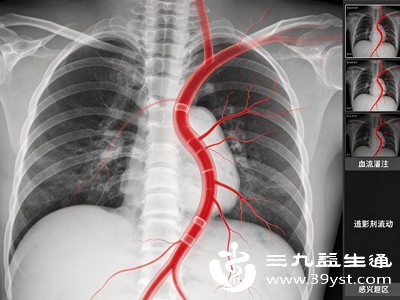 急性心肌梗死发作,需要紧急评估并可能同时进行介入治疗时,冠状动脉造影是首选检查 急性心肌梗死发作,需要紧急评估并可能同时进行介入治疗时,冠状动脉造影是首选检查