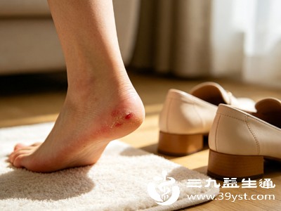 不要自行挑破未破裂的水泡,尤其是水泡较小、无明显不适时,强行挑破会增加感染风险 不要自行挑破未破裂的水泡,尤其是水泡较小、无明显不适时,强行挑破会增加感染风险