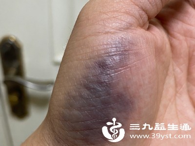 维生素K核心作用是参与凝血因子合成,缺乏后人体凝血能力下降,皮下微血管极易破裂 维生素K核心作用是参与凝血因子合成,缺乏后人体凝血能力下降,皮下微血管极易破裂