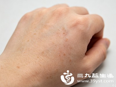 手部处于人体末梢,气血输送本就偏弱,如果气血不足或者血脉淤堵,代谢产生的色素垃圾无法及时随气血带走,停留在皮肤表层,慢慢形成色斑 手部处于人体末梢,气血输送本就偏弱,如果气血不足或者血脉淤堵,代谢产生的色素垃圾无法及时随气血带走,停留在皮肤表层,慢慢形成色斑