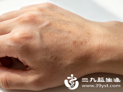 日常做家务频繁接触洗洁精、洗衣液、消毒液,或是长期接触化学物品,会持续破坏手部皮肤屏障。屏障受损后,皮肤抵御能力下降,黑色素更容易沉淀,形成炎症后色素沉着 日常做家务频繁接触洗洁精、洗衣液、消毒液,或是长期接触化学物品,会持续破坏手部皮肤屏障。屏障受损后,皮肤抵御能力下降,黑色素更容易沉淀,形成炎症后色素沉着