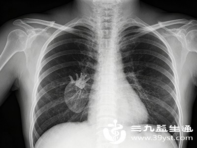 胸片(胸部X线片) 胸片(胸部X线片)