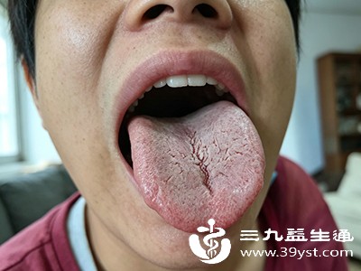 舌苔开裂别大意！可能是脏腑发出的求救信号，早了解早调理不踩坑
