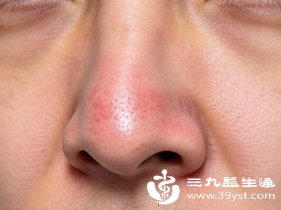 鼻子周围油脂分泌旺盛，马拉色菌增殖，会造成局部泛红，常伴随鼻翼、鼻尖起皮、轻微瘙痒，油脂看起来油腻发亮