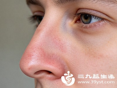 鼻子泛红明显时，可用常温干净纱布冷敷鼻尖，每次5分钟，帮助舒缓扩张的血管