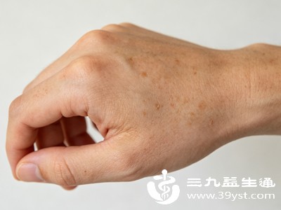 手背发黑不是小事 分清原因再处理 既美观又护健康