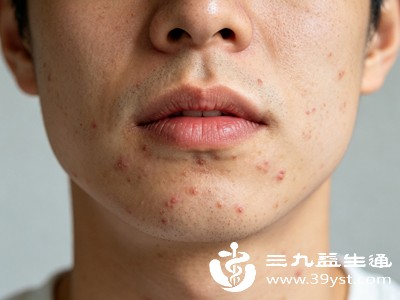 很多家长和孩子的错误操作,会让小痘痘变成顽固痘、留下永久痘印痘坑 很多家长和孩子的错误操作,会让小痘痘变成顽固痘、留下永久痘印痘坑