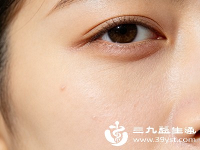 结构型黑眼圈：岁月留下的“痕迹”