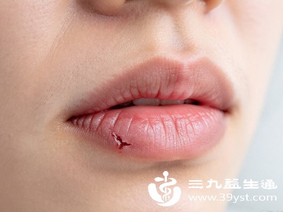 维生素B2缺乏,常与口角炎、唇部干裂、脱屑有关 维生素B2缺乏,常与口角炎、唇部干裂、脱屑有关