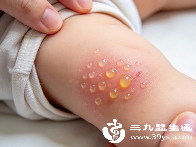 宝宝烫伤起泡多久能愈合 轻度中度区别大 科学护理是关键
