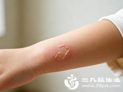 若烫伤后水泡破裂,创面出现红肿范围扩大、渗液增多且变浑浊,或有脓液、异味,伴随宝宝发热、哭闹不止等感染迹象,或烫伤面积较大,愈合时间会显著延长,可能需要30天以上,甚至更久 若烫伤后水泡破裂,创面出现红肿范围扩大、渗液增多且变浑浊,或有脓液、异味,伴随宝宝发热、哭闹不止等感染迹象,或烫伤面积较大,愈合时间会显著延长,可能需要30天以上,甚至更久