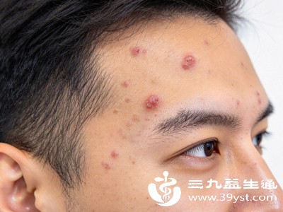 肝脏主疏泄,负责调节体内气机,当肝火过旺时,会导致气血运行不畅,热气积聚在头部,进而诱发额头痘痘 肝脏主疏泄,负责调节体内气机,当肝火过旺时,会导致气血运行不畅,热气积聚在头部,进而诱发额头痘痘
