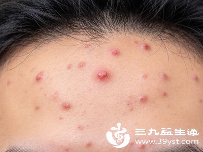 如果额头长痘伴随明显的“上火”症状,可根据“心火”“肝火”的不同针对性调理 如果额头长痘伴随明显的“上火”症状,可根据“心火”“肝火”的不同针对性调理
