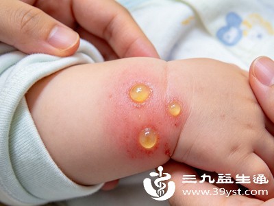 部分人被红火蚁、黄蚁等攻击性较强的蚂蚁叮咬后,会出现大面积红肿,甚至起水泡 部分人被红火蚁、黄蚁等攻击性较强的蚂蚁叮咬后,会出现大面积红肿,甚至起水泡